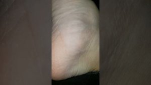 Фасцикуляции на стопе, (произвольные дергаение мышц )