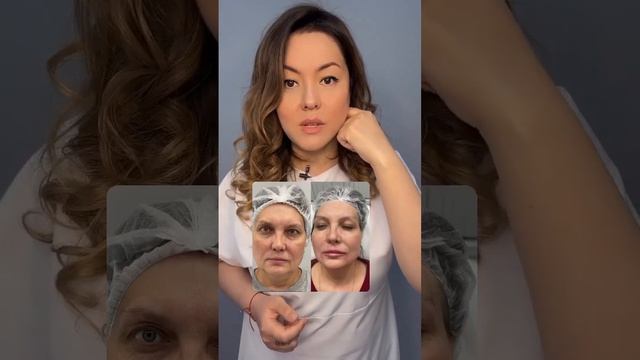 Тредлифтинг лица нитями Aptos