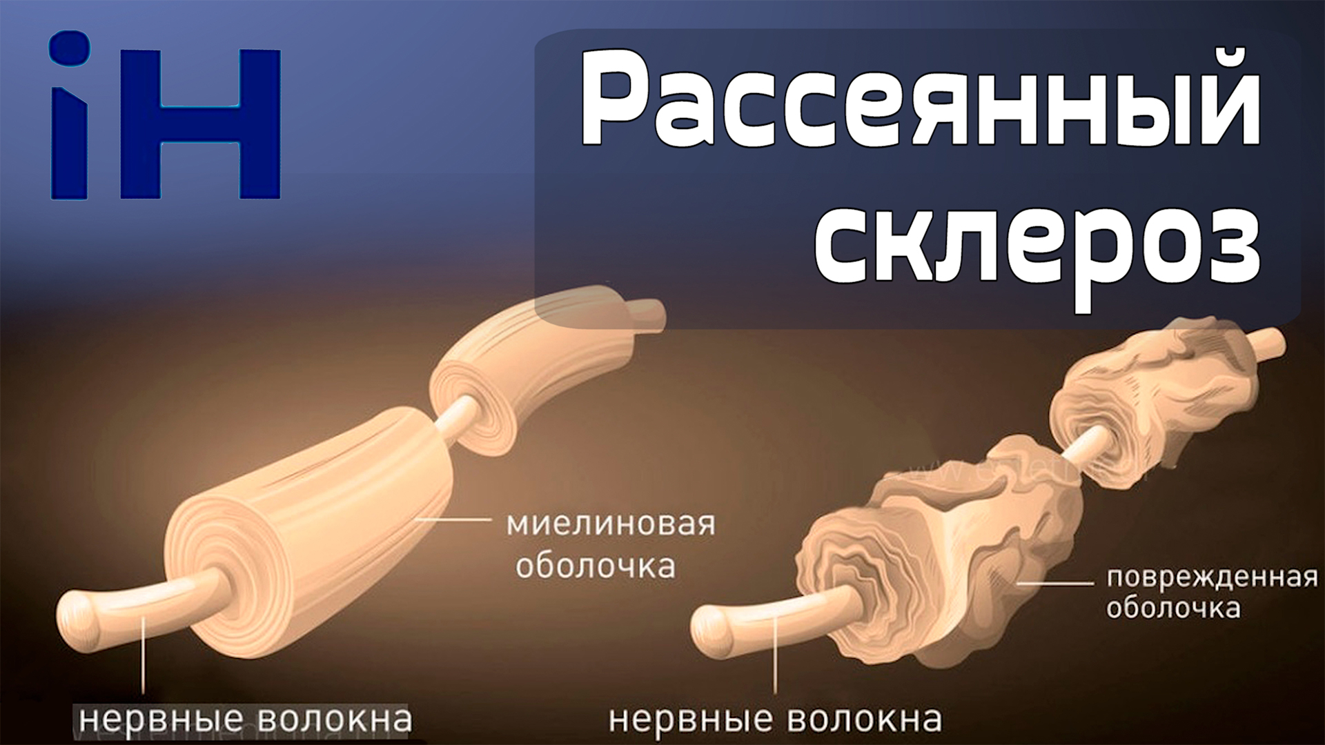 Демиелинизация