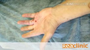 Лечение контрактуры Дюпюитрена в Reaclinic