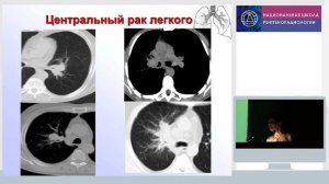 Лучевая диагностика рака легкого
