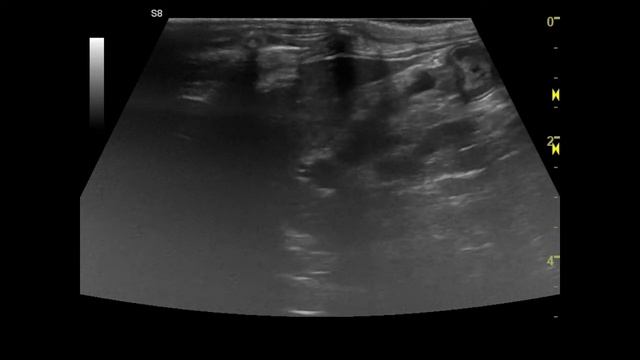 Расширенный холедох, свободная жидкость в брюшной полости, лимфоаденопатия у кошки на УЗИ смотреть онлайн