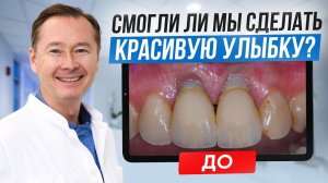 Смогли ли мы сделать красивую улыбку пациентке, которая была недовольна эстетическим результатом?