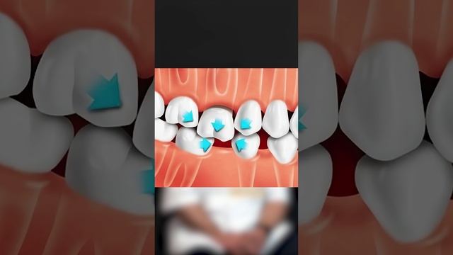 Почему важно восстановить утраченный зуб?