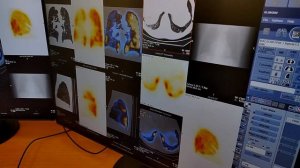 Гибридное исследование сердца: перфузионная сцинтиграфия миокарда + КТ-коронография