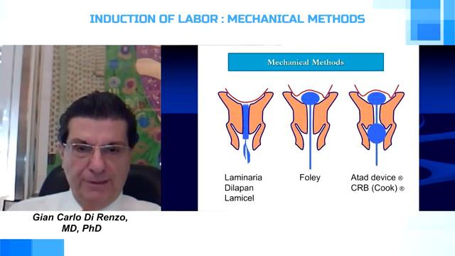 Induction of labour prof GC Di Renzo смотреть онлайн