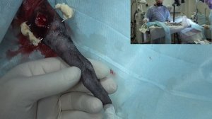 Залом хвоста исправление.  несколько клиновидных позвонков остеотомия.