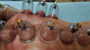 Вакуумные банки малышам.mp4