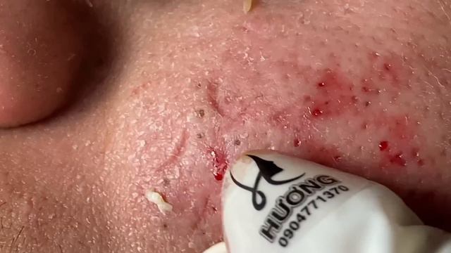 Make your Acne Treatment Huong Da Nang#496 | acne 2022 Part2 смотреть онлайн