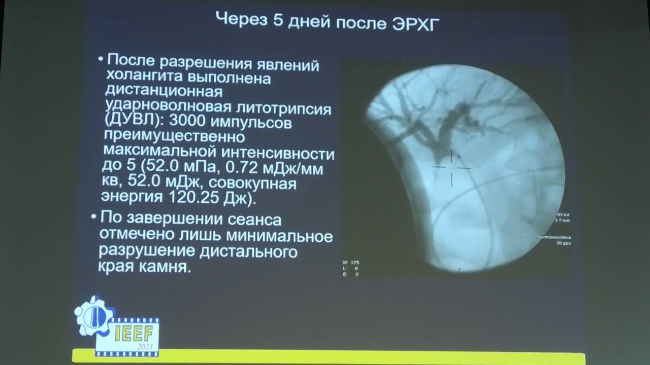 51 Воробьева ЕА Первый опыт применения суперимпульсного фиброволоконного тулиевого лазера при контак