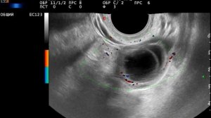 Фолликул в фолликуле