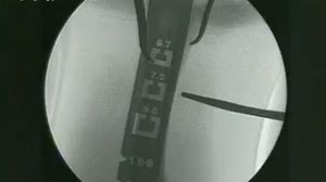 Ретроградный остеосинтез плечевой кости блокируемым стержнем