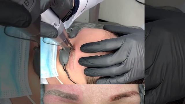 Лазерное удаление татуажа смотреть онлайн