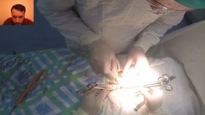 Герниопластика по Мейо. Установка аутотрансплантата Sublay/Herniaplastic Meyo. SubLay autotransplan