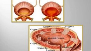 Психосоматика мочевого пузыря: Цистит/ Рак мочевого пузыря