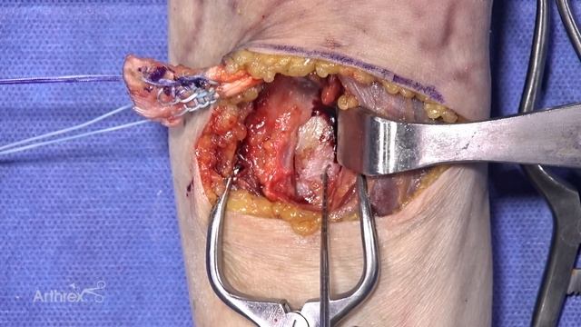 Anterior Distal Biceps Onlay Repair With Cortical Buttons смотреть онлайн