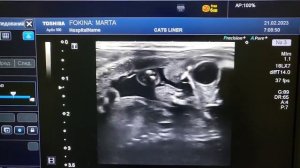 Ультразвуковой аппарат Toshiba Aplio 500