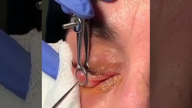 Удаление халазиона. Chalasion смотреть онлайн