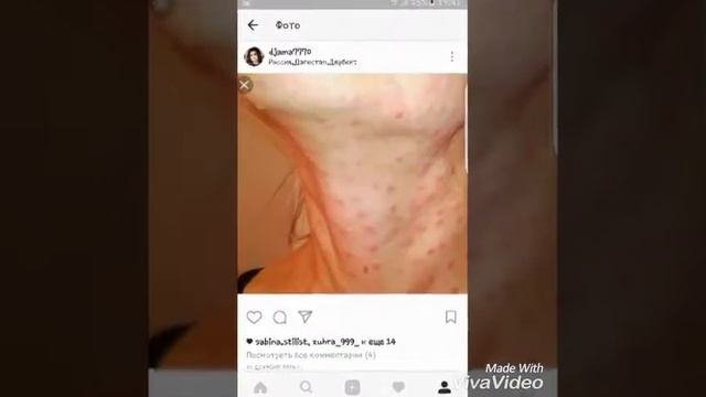 У дипломировонный косметолога АКЦИИ НА УВЕЛИЧЕНИЕ губ  запись 89285773764