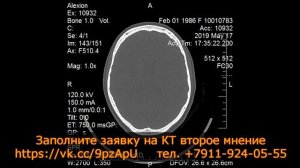 КИСТЫ ПРИДАТОЧНЫХ ПАЗУХ НОСА после проведения КТ второго мнения