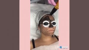 Карбоновый Лазерный пилинг От и До