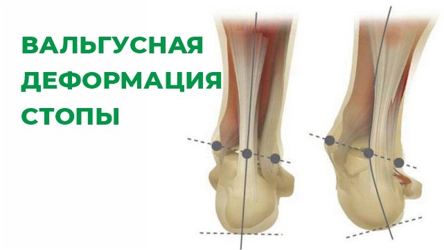 Операция на вальгус стопы отзывы. Железнодорожная больница операция хальгус вальгус.