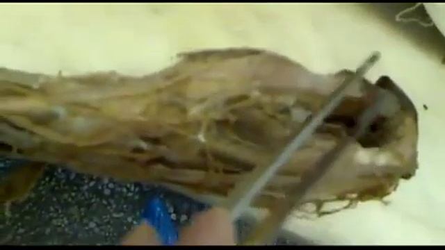 Плечевое сплетение (длинные ветви) смотреть онлайн