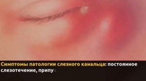 Зондирование слезных каналов