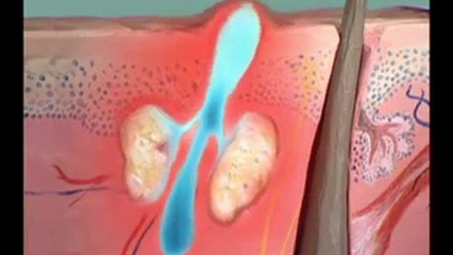 Здоровье с Еленой Малышевой О Лечении Прыщей смотреть онлайн