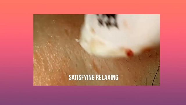 Успокаивающее расслабление, удаление черных точек # 08 ,Satisfying Relaxing смотреть онлайн