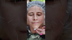 Акупунктура. Фейслифтинг.