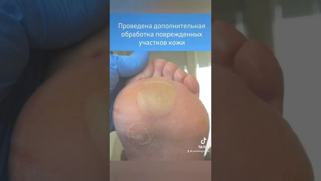 Случай из практики 3: химический ожог #подология #podologyclinic #клиникаподологии #podology