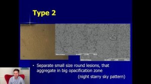 Помутнения гидрофильных интраокулярных линз
