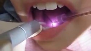 Лазерное подрезание уздечки языка