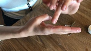 Как обезболить мозоль, когда лопнул водяной волдырь