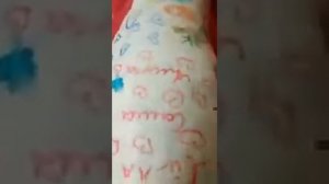 Нога в гипсе_14