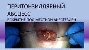 паратонзиллярный перитонзиллярный абсцесс горла нёбных миндалин абсцесс гланд при хроническом тонзил