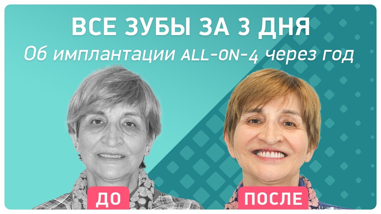Все зубы за 3 дня: об имплантации all-on-4 через 1 год