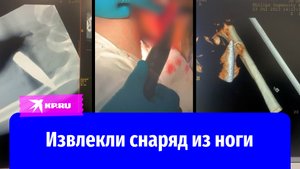 Военные врачи извлекли неразорвавшийся снаряд из ноги бойца