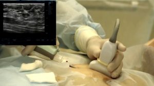 Вакуумно-аспирационная биопсия.