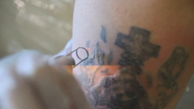 Удаление татуировки - до и после. (1 процедура) смотреть онлайн
