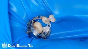 Изоляция корня 15 для ревизии корневого канала кламп 13А и B4 DET.expert & Sanctuary 4K