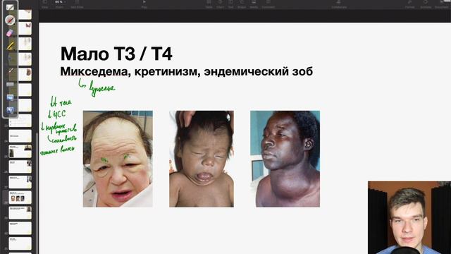 6.93. Заболевания щитовидной железы | Анатомия к ЕГЭ | Георгий Мишуровский смотреть онлайн