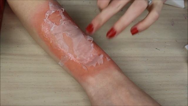 1st, 2nd, and 3rd Degree Burns Tutorial смотреть онлайн