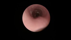 Stridor in 8 day old baby.