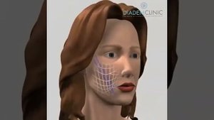 Нитевой лифтинг Luxeface - Diadem-Clinic