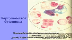 Канцероматоз брюшины
