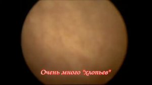 Лейкоплакия мочевого пузыря. Хронический цистит. Цистоскопия. Уретроскопия. Лечение.