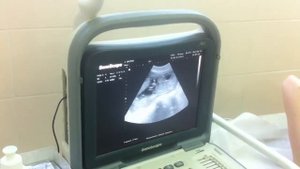 Узи двойни, 15-16 недель | Twins Ultrasound (15-16 weeks)