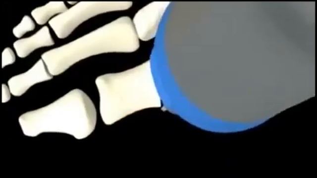 Как вылечить шишки на ногах МНЕНИЕ ЭКСПЕРТА! смотреть онлайн